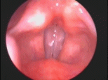 animated movie of the vocal  folds created using precision stroboscopy. click to download full movie.