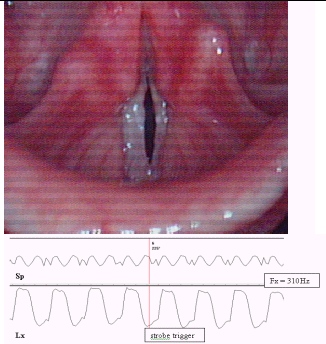image of vocal folds from a stroboscopic sequence and  corresponding signals beneath